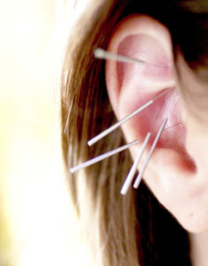 Auricular Acupuncture